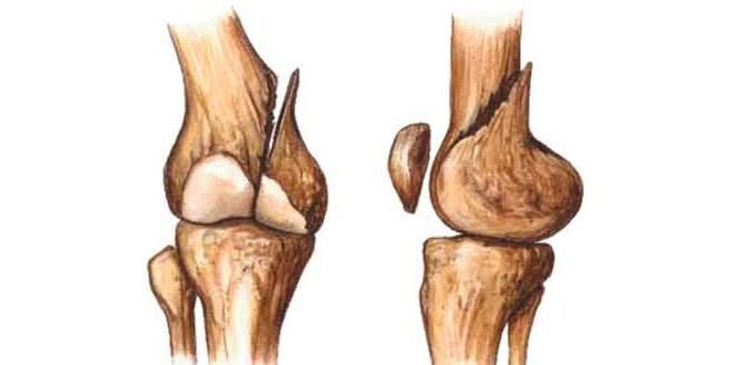 Alimenti per la cura delle ossa rotte