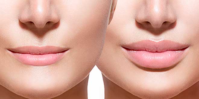 Acido ialuronico labbra