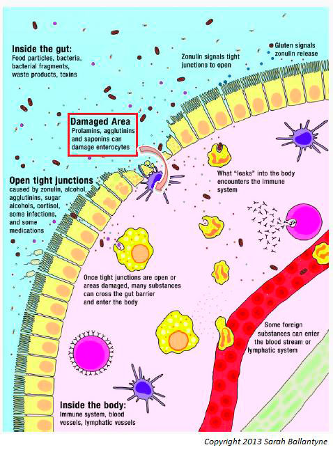 Intestino permeabile Intestino permeabile