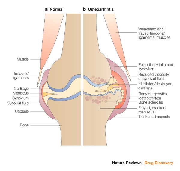 Cartilagine e osteoartrosi