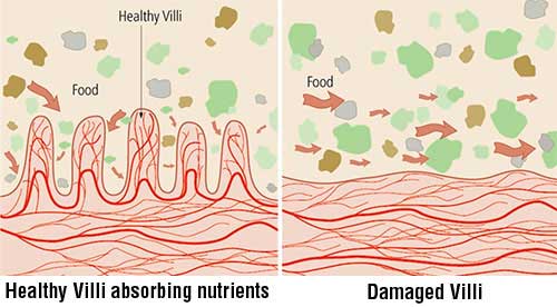 Infiammazione dei villi intestinali nei celiaci