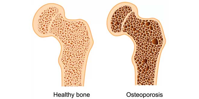 Come agisce l'osteoporosi