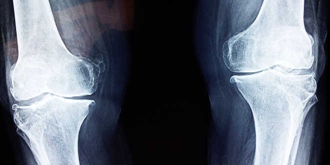 Glucosammina per la cartilagine