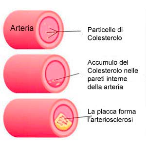 Accumulo di colesterolo nelle arterie Accumulo di colesterolo nelle arterie