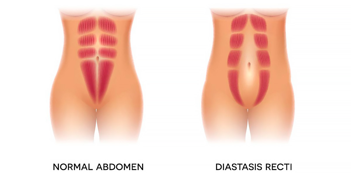 Addome con diastasi vs addome normale