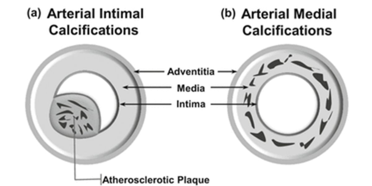 Calcificazione vascolare Calcificazione vascolare