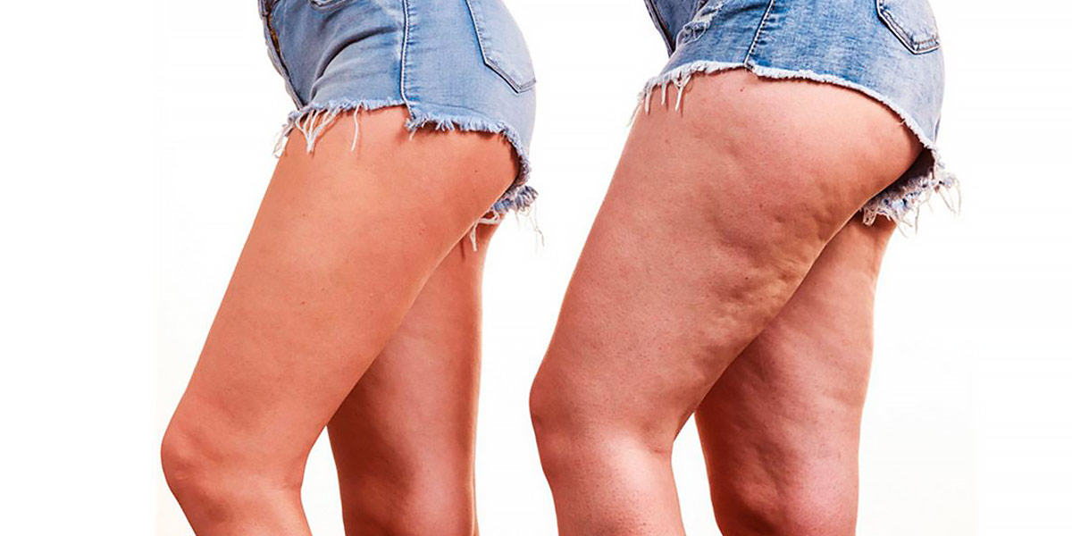 Come evitare la cellulite