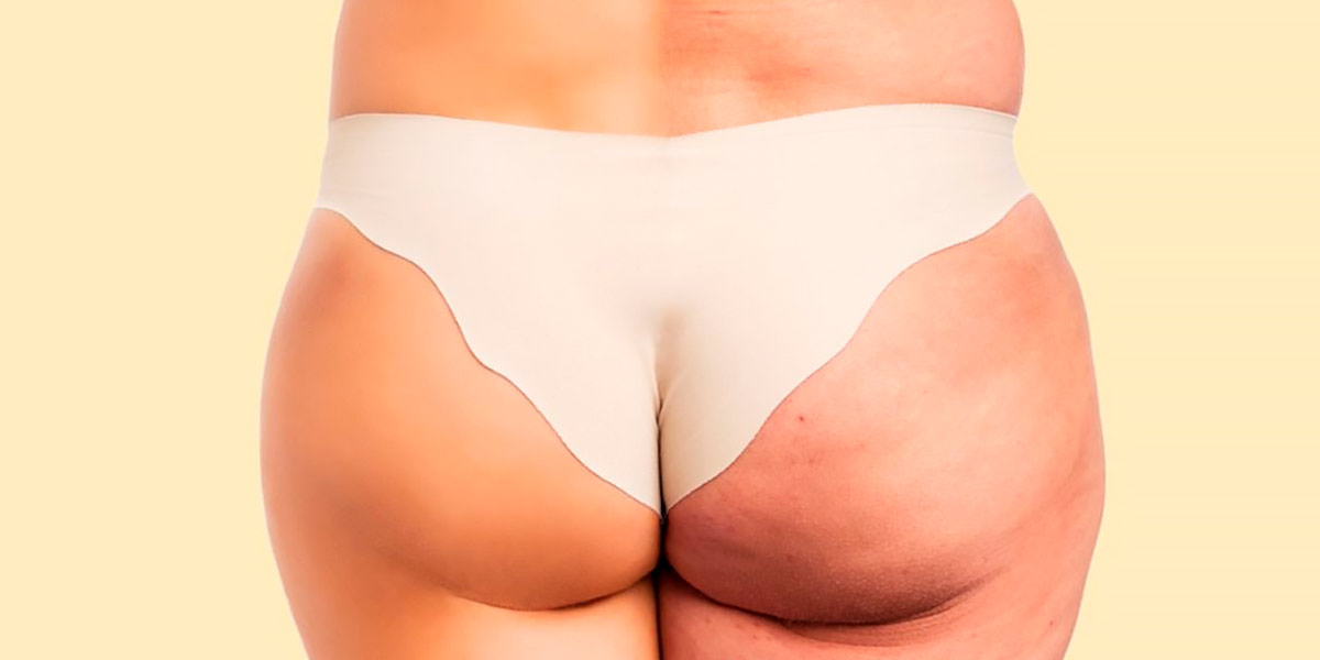 Ridurre la Cellulite