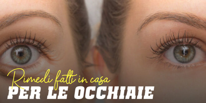 Occhiaie: Ti diciamo i Migliori Rimedi Casalinghi