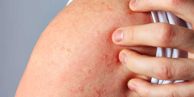 Dermatite da contatto Dermatite da contatto