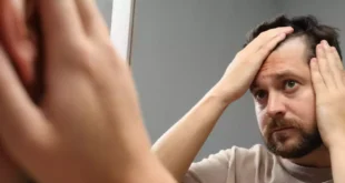 Come trattare l’alopecia ed evitare la caduta dei capelli