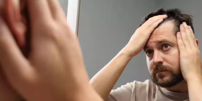 Come trattare l’alopecia ed evitare la caduta dei capelli Come trattare l’alopecia ed evitare la caduta dei capelli