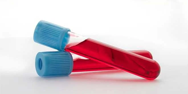 Parametri strani nelle analisi quando si usano steroidi Parametri strani nelle analisi quando si usano steroidi